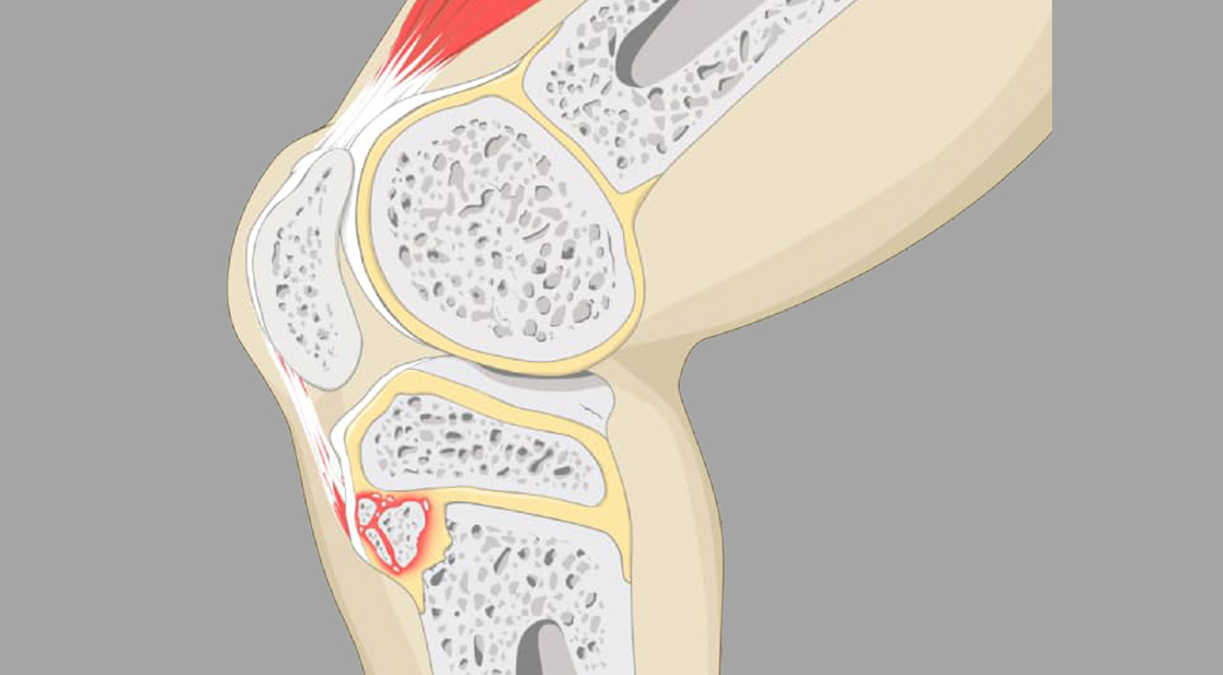 Síndrome de Osgood Schlatter
